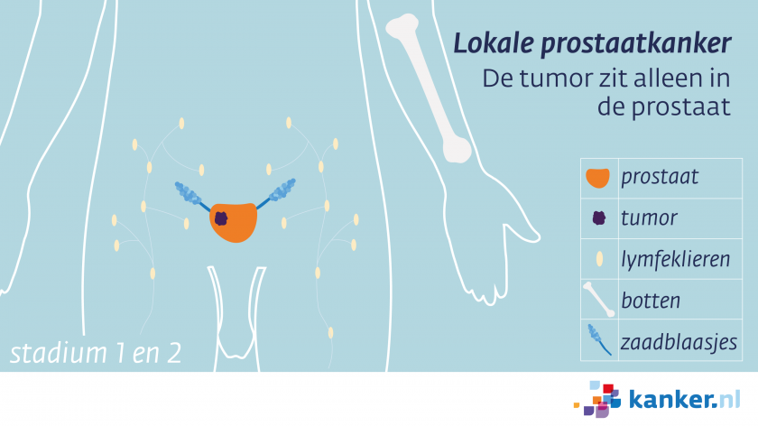 Het stadium van prostaatkanker | Kanker.nl